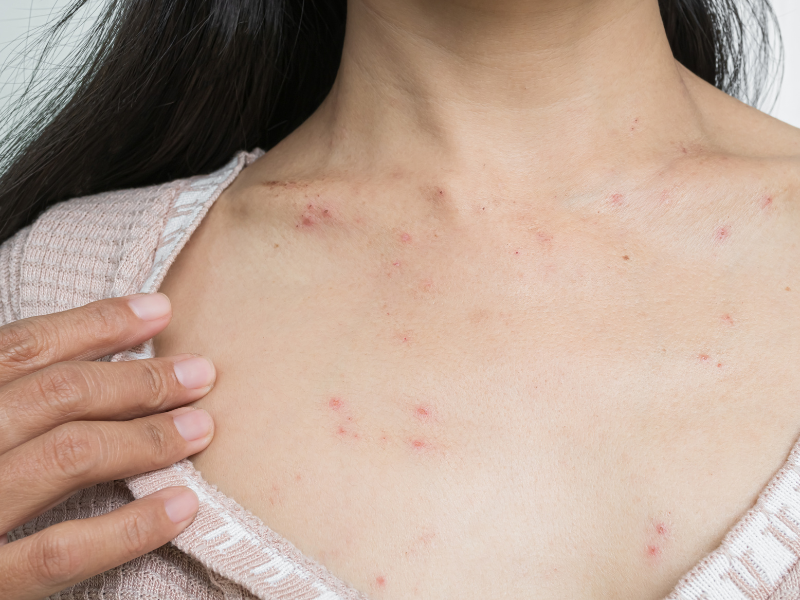 Diagnosi per orticaria a Napoli